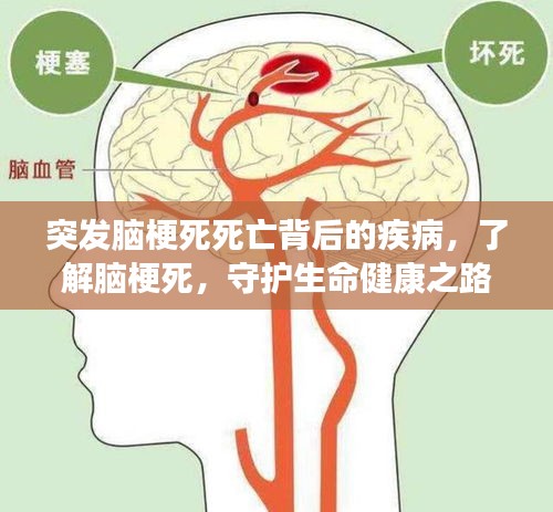 突發(fā)腦梗死死亡背后的疾病，了解腦梗死，守護(hù)生命健康之路