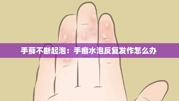 手蘚不斷起泡：手癬水泡反復(fù)發(fā)作怎么辦 