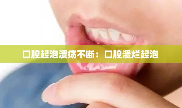 口腔起泡潰瘍不斷：口腔潰爛起泡 