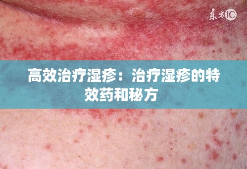 高效治療濕疹：治療濕疹的特效藥和秘方 