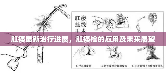 肛瘺最新治療進(jìn)展，肛瘺栓的應(yīng)用及未來(lái)展望