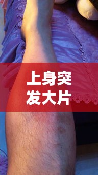上身突發(fā)大片紅斑，原因、癥狀與處理方法探討